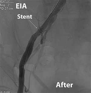 Iliac Artery Stenting For Stenosis