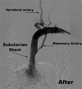 Subclavian Artery Stenting