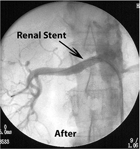Renal Artery Stenting