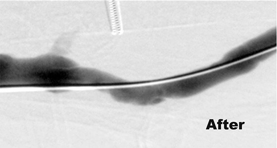 Haemodialysis Fistulae