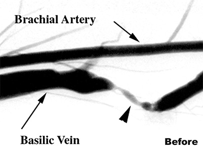 Haemodialysis Fistulae