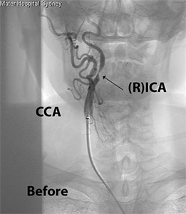 Carotid Artery Stenting