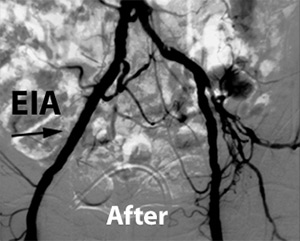 Iliac Artery Stenting