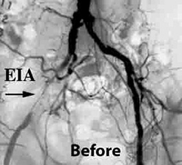 Iliac Artery Stenting