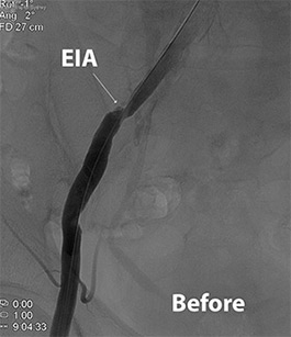 Iliac Artery Stenting For Stenosis