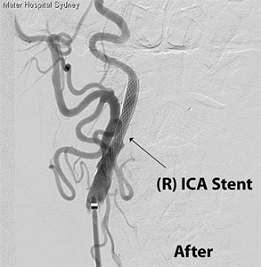 Carotid Artery Stenting