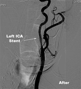 Carotid Artery Stenting