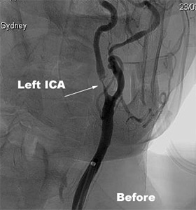 Carotid Artery Stentings