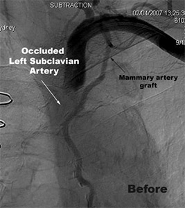 Subclavian Artery Stenting