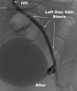 Venous Stenting