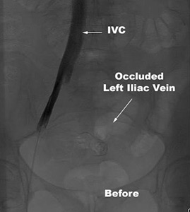 Venous Stenting