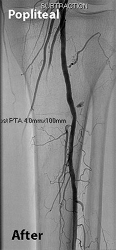 Infrapopliteal Revascularisation