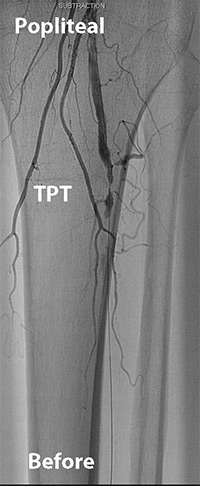 Infrapopliteal Revascularisation