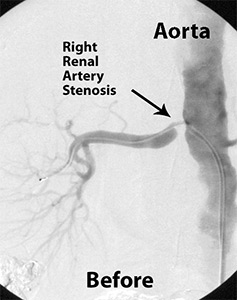 Renal Artery Stenting