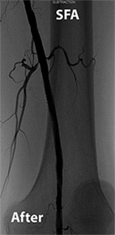 Femoral Artery Intervention