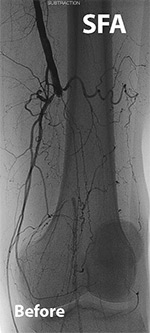 Femoral Artery Intervention